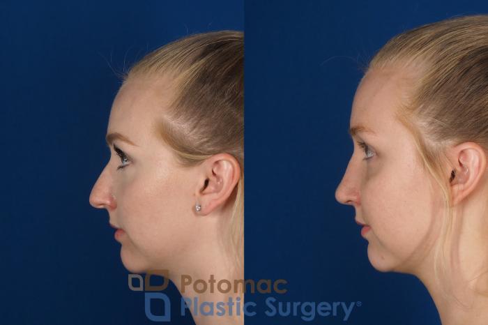 Before & After Rhinoplasty - Cosmetic Case 318 Left Side View in Washington DC & Arlington , DC
