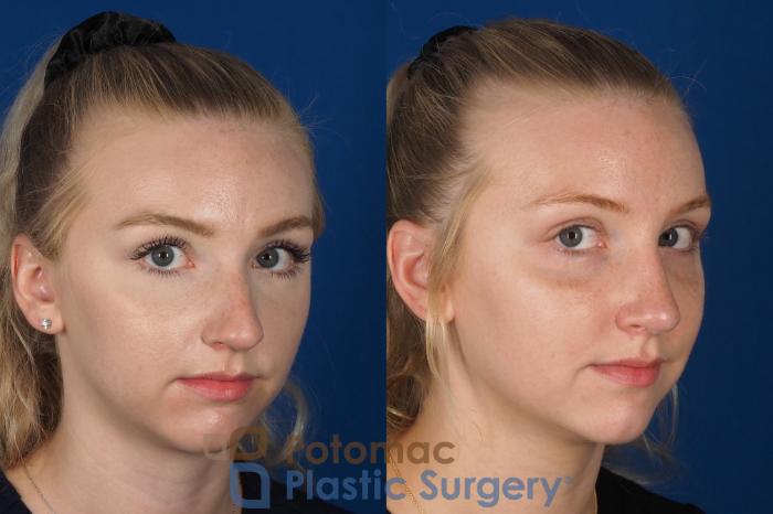 Before & After Rhinoplasty - Cosmetic Case 318 Right Oblique 2 View in Washington DC & Arlington , DC