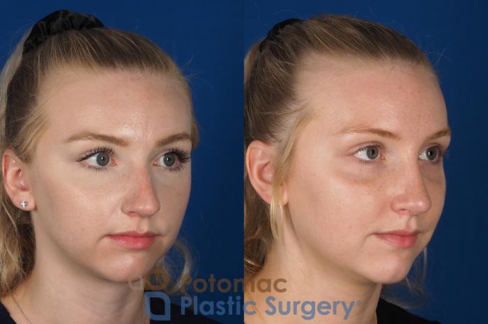 Before & After Rhinoplasty - Cosmetic Case 318 Right Oblique View in Washington DC & Arlington , DC
