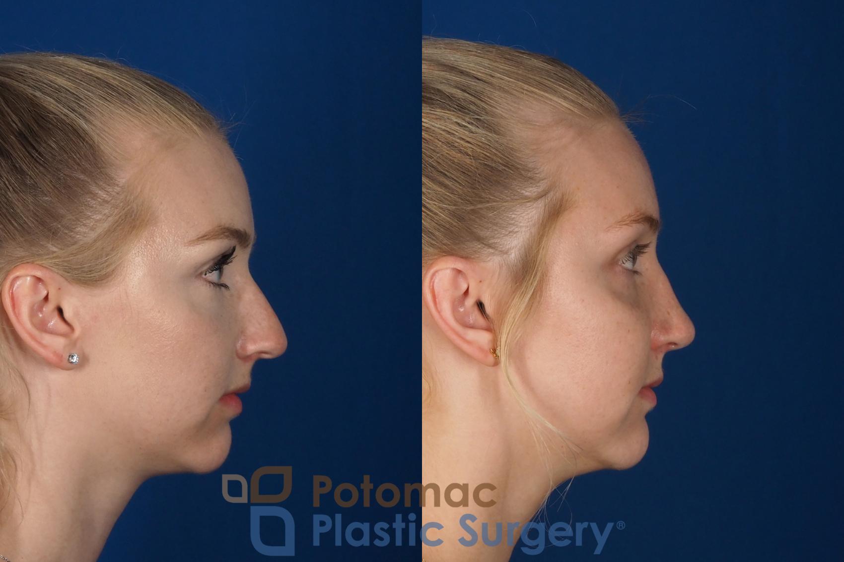 Before & After Rhinoplasty - Cosmetic Case 318 Right Side View in Washington DC & Arlington , DC