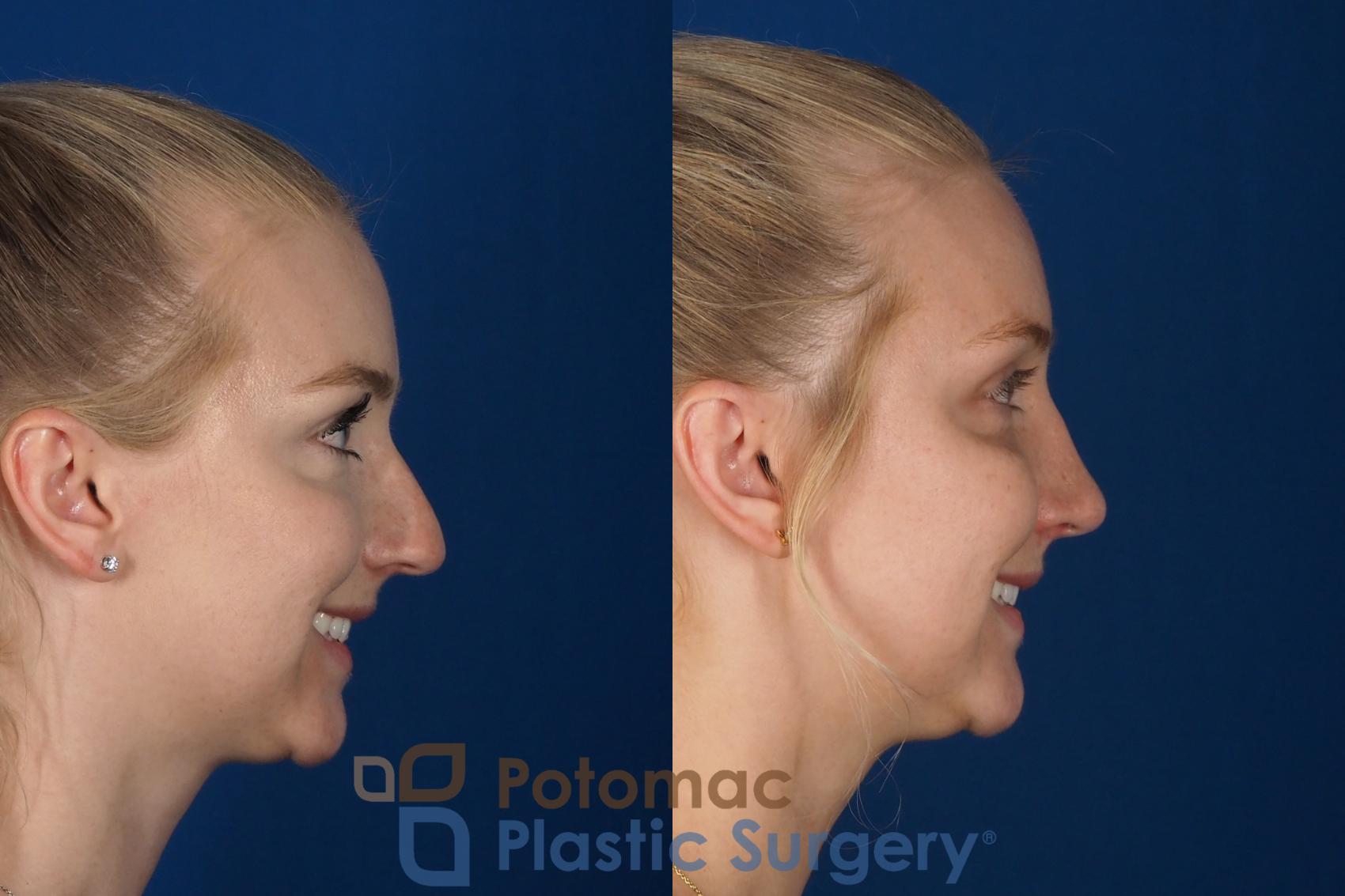 Before & After Rhinoplasty - Cosmetic Case 318 Right - Smiling View in Washington DC & Arlington , DC