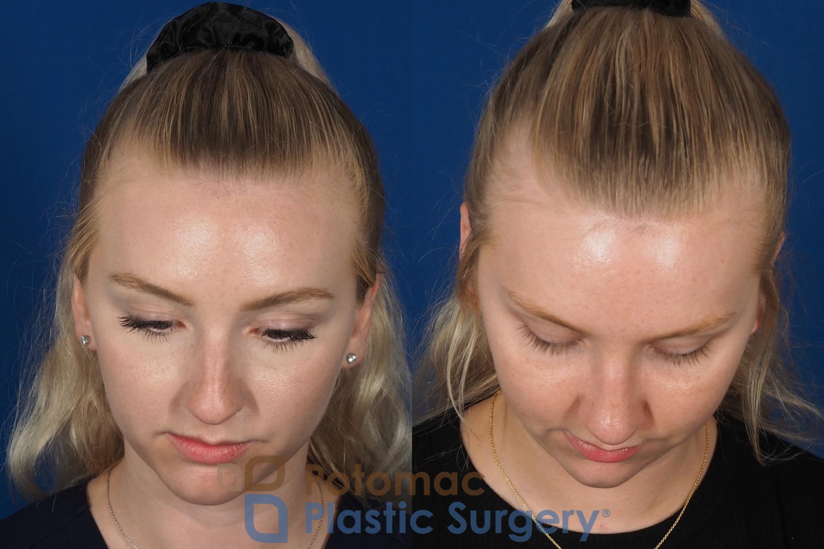 Before & After Rhinoplasty - Cosmetic Case 318 Top View in Washington DC & Arlington , DC