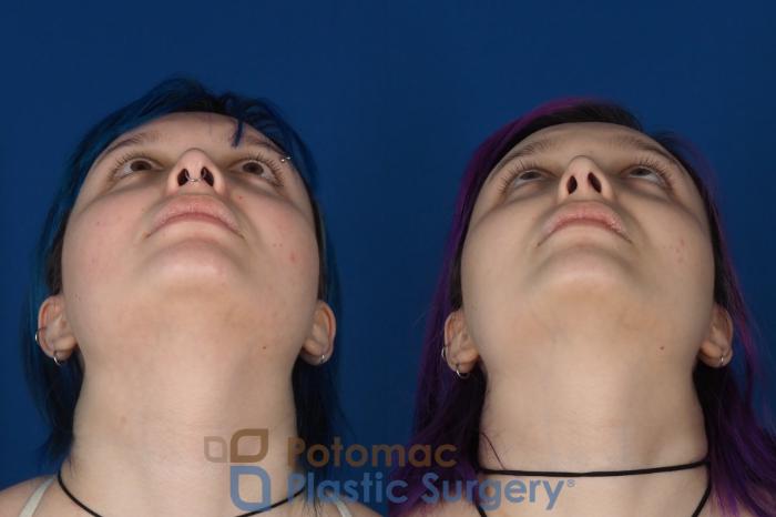 Before & After Rhinoplasty - Cosmetic Case 319 Bottom View in Washington DC & Arlington , DC