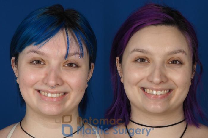 Before & After Rhinoplasty - Cosmetic Case 319 Front - Smiling View in Washington DC & Arlington , DC