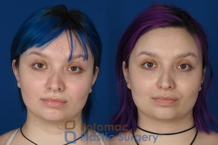 Before & After Rhinoplasty - Cosmetic Case 319 Front View in Washington, DC