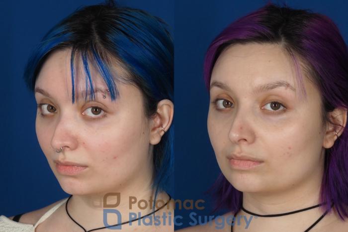 Before & After Rhinoplasty - Cosmetic Case 319 Left Oblique 2 View in Washington DC & Arlington , DC