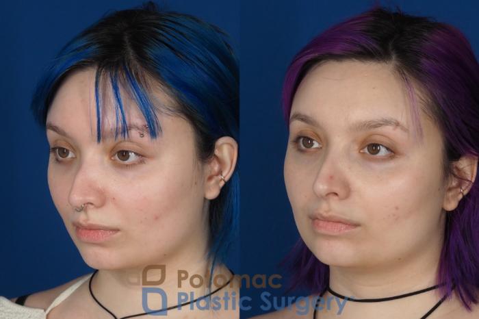 Before & After Rhinoplasty - Cosmetic Case 319 Left Oblique View in Washington DC & Arlington , DC