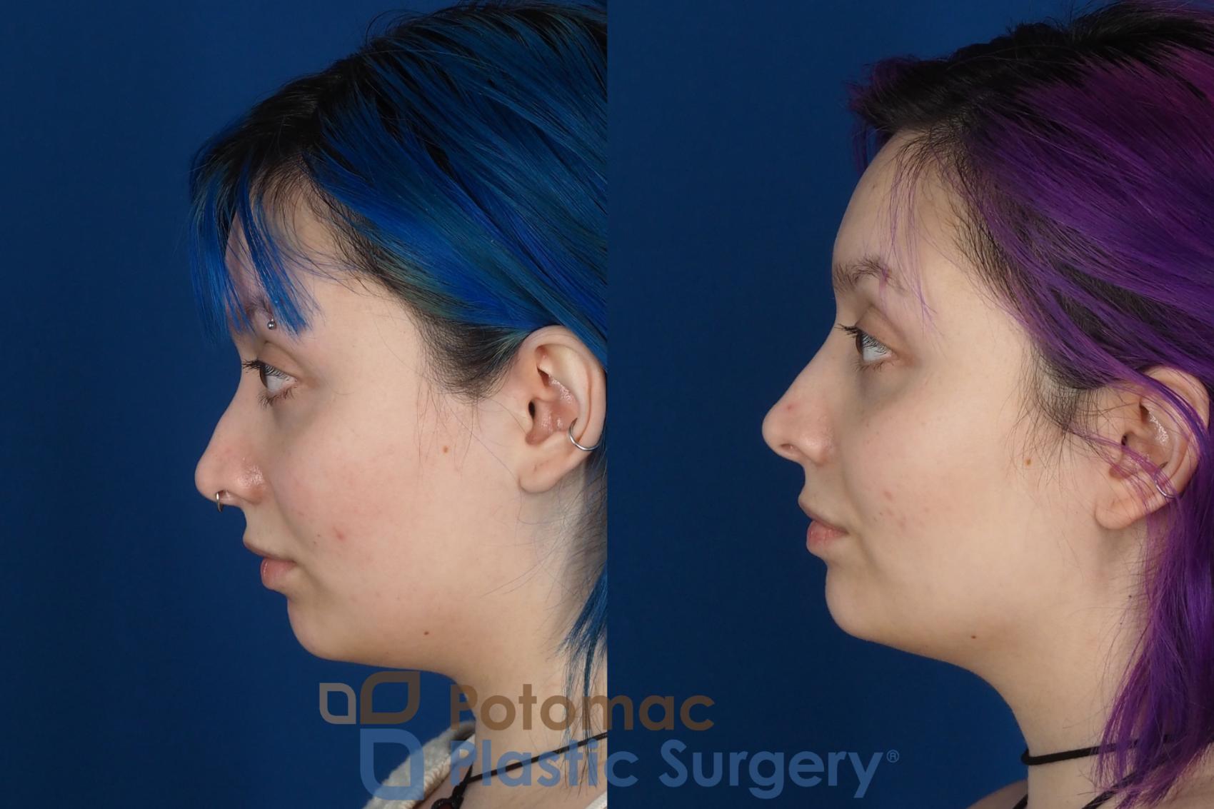 Before & After Rhinoplasty - Cosmetic Case 319 Left Side View in Washington DC & Arlington , DC