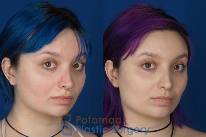 Before & After Dermal Fillers Case 319 Right Oblique 2 View in Washington DC & Arlington , DC