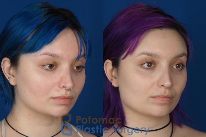 Before & After Dermal Fillers Case 319 Right Oblique View in Washington DC & Arlington , DC