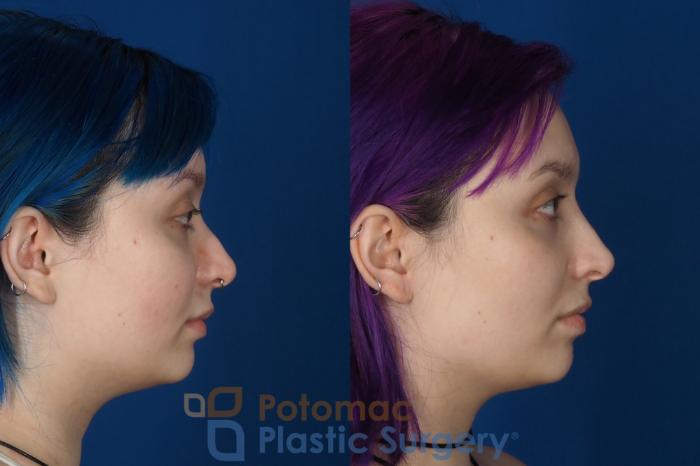 Before & After Dermal Fillers Case 319 Right Side View in Washington DC & Arlington , DC