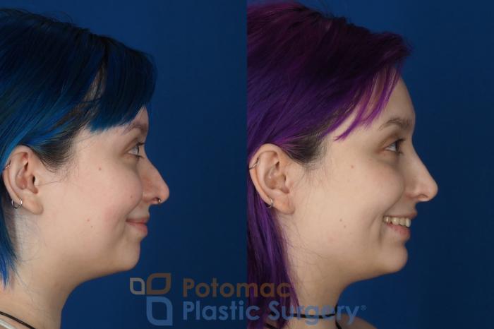 Before & After Dermal Fillers Case 319 Right - Smiling View in Washington DC & Arlington , DC