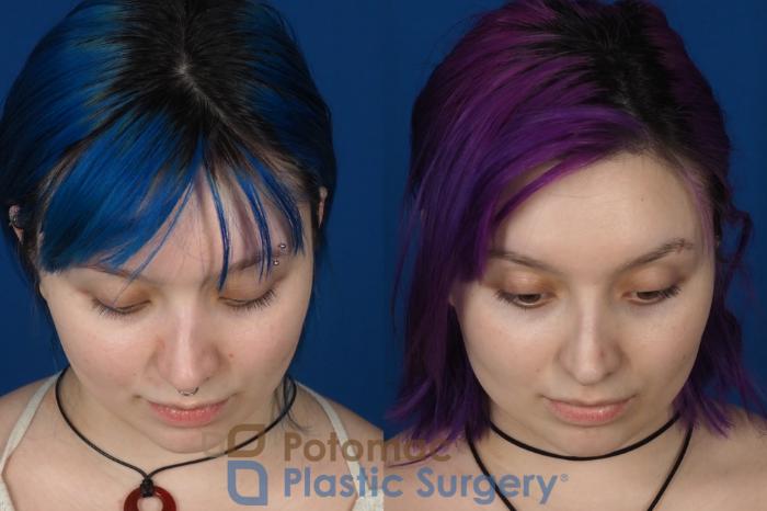 Before & After Rhinoplasty - Cosmetic Case 319 Top View in Washington DC & Arlington , DC