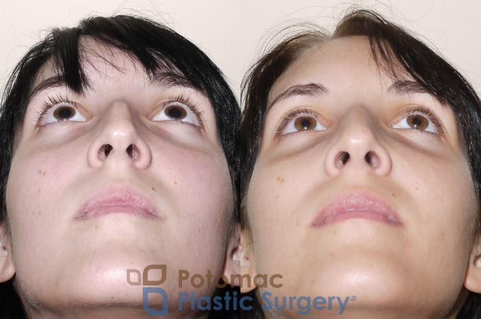 Before & After Rhinoplasty - Medical Case 32 Below View in Washington DC & Arlington , DC