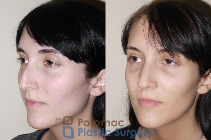 Before & After Rhinoplasty - Cosmetic Case 32 Left Oblique View in Washington DC & Arlington , DC