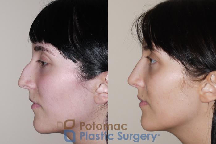 Before & After Rhinoplasty - Medical Case 32 Left Side View in Washington DC & Arlington , DC
