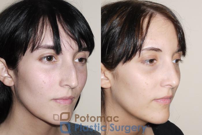 Before & After Rhinoplasty - Cosmetic Case 32 Right Oblique View in Washington DC & Arlington , DC