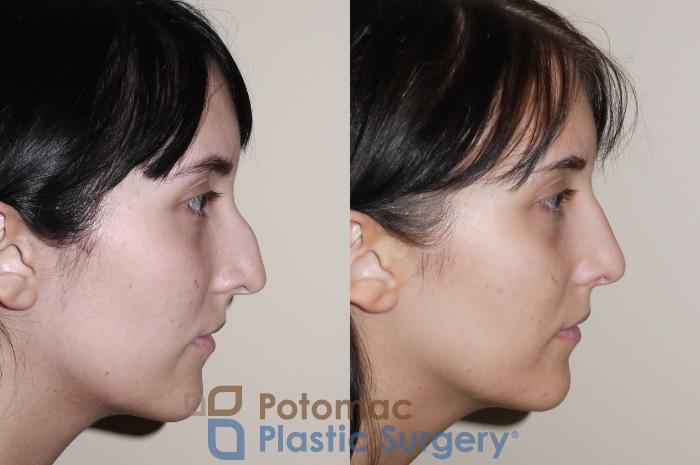 Before & After Rhinoplasty - Medical Case 32 Right Side View in Washington DC & Arlington , DC