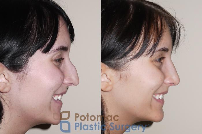 Before & After Rhinoplasty - Medical Case 32 Right Side View #2 View in Washington DC & Arlington , DC