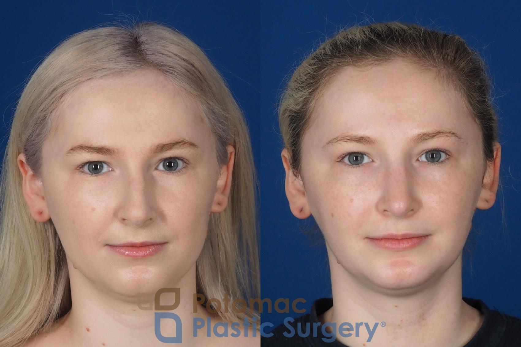 Before & After Rhinoplasty - Cosmetic Case 321 Front View in Washington DC & Arlington , DC