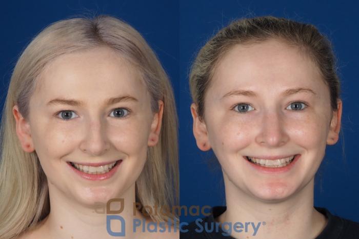 Before & After Rhinoplasty - Cosmetic Case 321 Front - Smiling View in Washington DC & Arlington , DC
