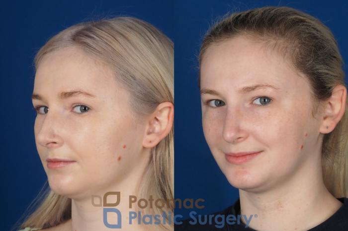 Before & After Rhinoplasty - Cosmetic Case 321 Left Oblique 2 View in Washington DC & Arlington , DC
