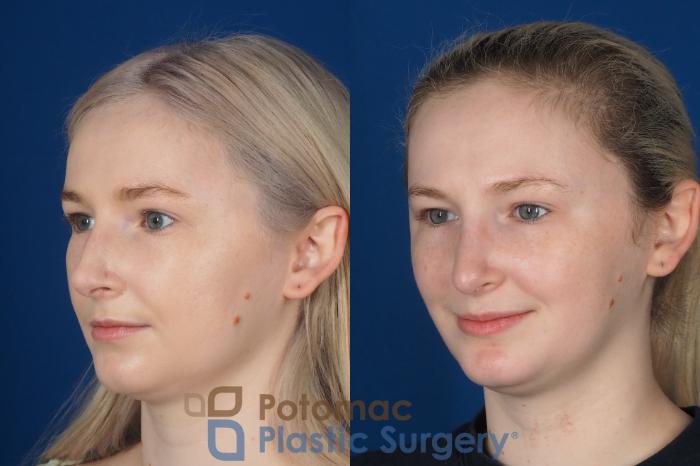 Before & After Rhinoplasty - Cosmetic Case 321 Left Oblique View in Washington DC & Arlington , DC