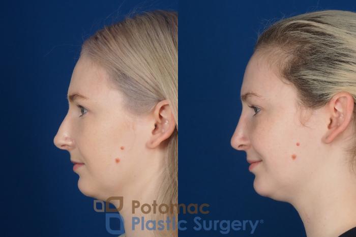Before & After Rhinoplasty - Medical Case 321 Left Side View in Washington DC & Arlington , DC