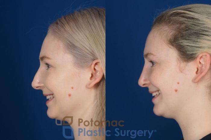 Before & After Rhinoplasty - Medical Case 321 Left - Smiling View in Washington DC & Arlington , DC