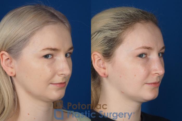 Before & After Rhinoplasty - Cosmetic Case 321 Right Oblique 2 View in Washington DC & Arlington , DC