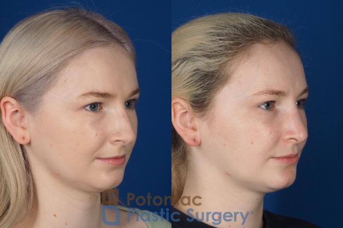 Before & After Rhinoplasty - Cosmetic Case 321 Right Oblique View in Washington DC & Arlington , DC