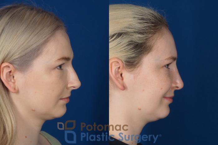 Before & After Rhinoplasty - Medical Case 321 Right Side View in Washington DC & Arlington , DC