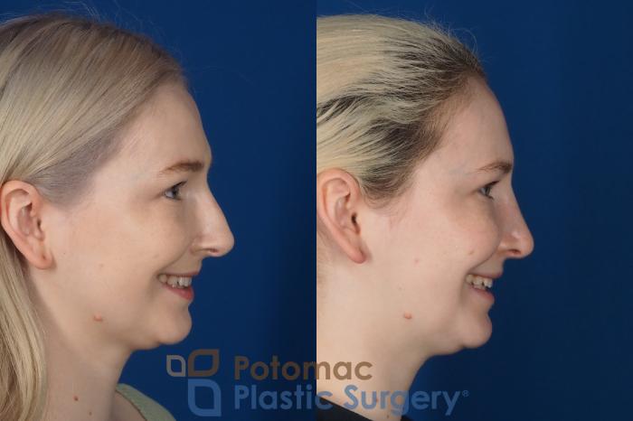 Before & After Rhinoplasty - Cosmetic Case 321 Right - Smiling View in Washington DC & Arlington , DC