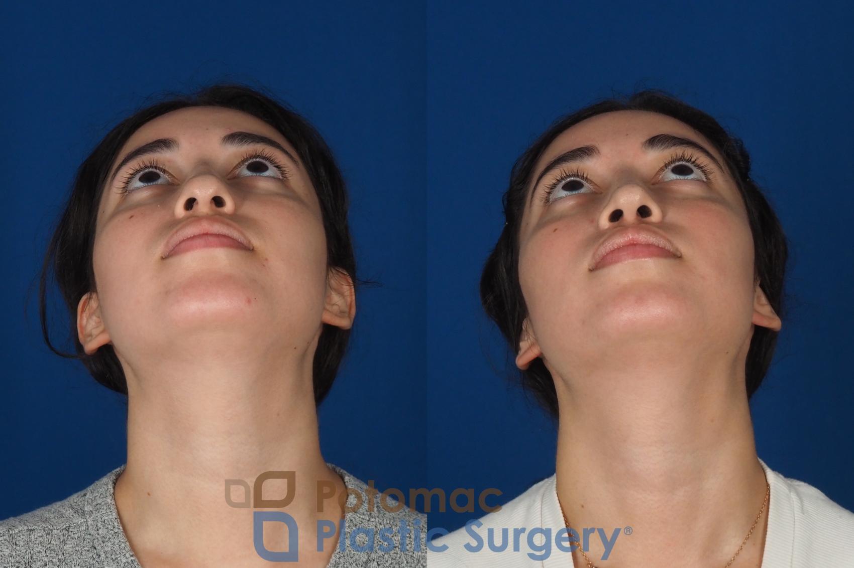 Before & After Rhinoplasty - Cosmetic Case 322 Bottom View in Washington DC & Arlington , DC