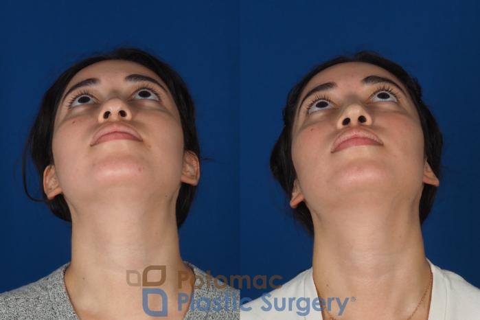 Before & After Rhinoplasty - Medical Case 322 Bottom View in Washington DC & Arlington , DC