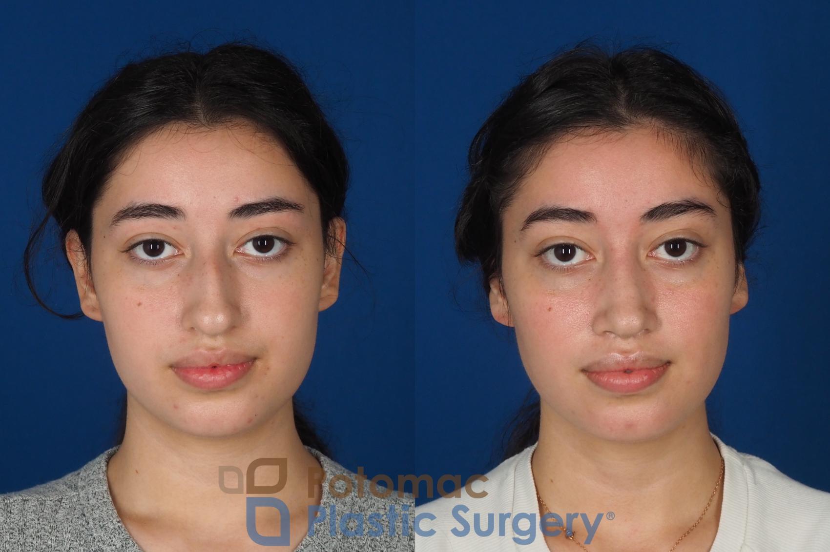 Before & After Rhinoplasty - Cosmetic Case 322 Front View in Washington DC & Arlington , DC
