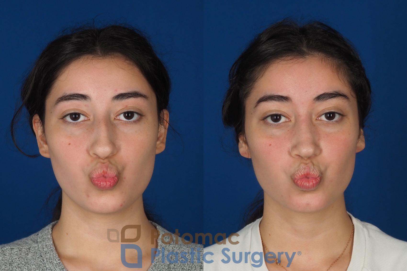 Before & After Rhinoplasty - Cosmetic Case 322 Front - Puckering View in Washington DC & Arlington , DC