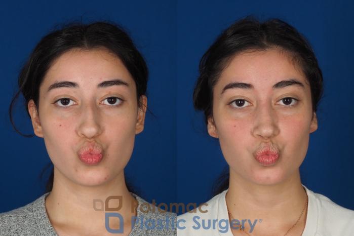 Before & After Rhinoplasty - Cosmetic Case 322 Front - Puckering View in Washington DC & Arlington , DC