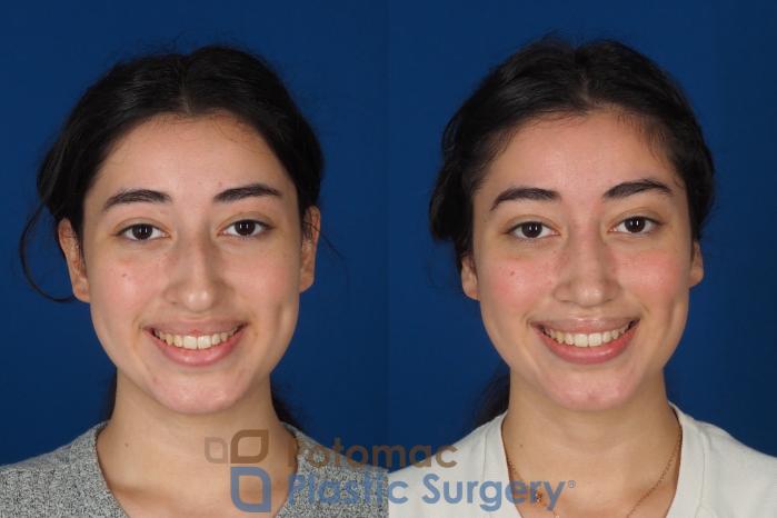 Before & After Rhinoplasty - Medical Case 322 Front - Smiling View in Washington DC & Arlington , DC