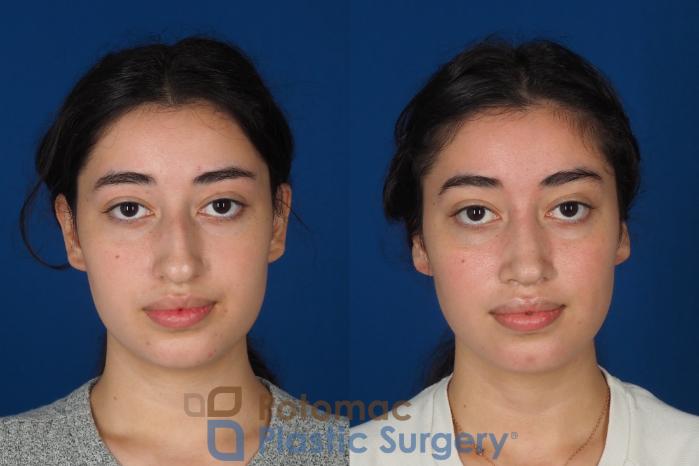 Before & After Rhinoplasty - Medical Case 322 Front View in Washington DC & Arlington , DC
