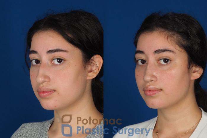Before & After Rhinoplasty - Cosmetic Case 322 Left Oblique 2 View in Washington DC & Arlington , DC