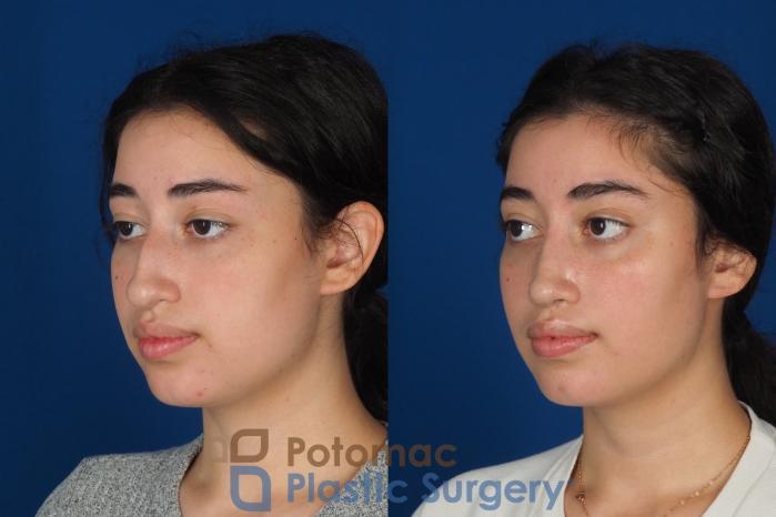 Before & After Rhinoplasty - Cosmetic Case 322 Left Oblique View in Washington DC & Arlington , DC