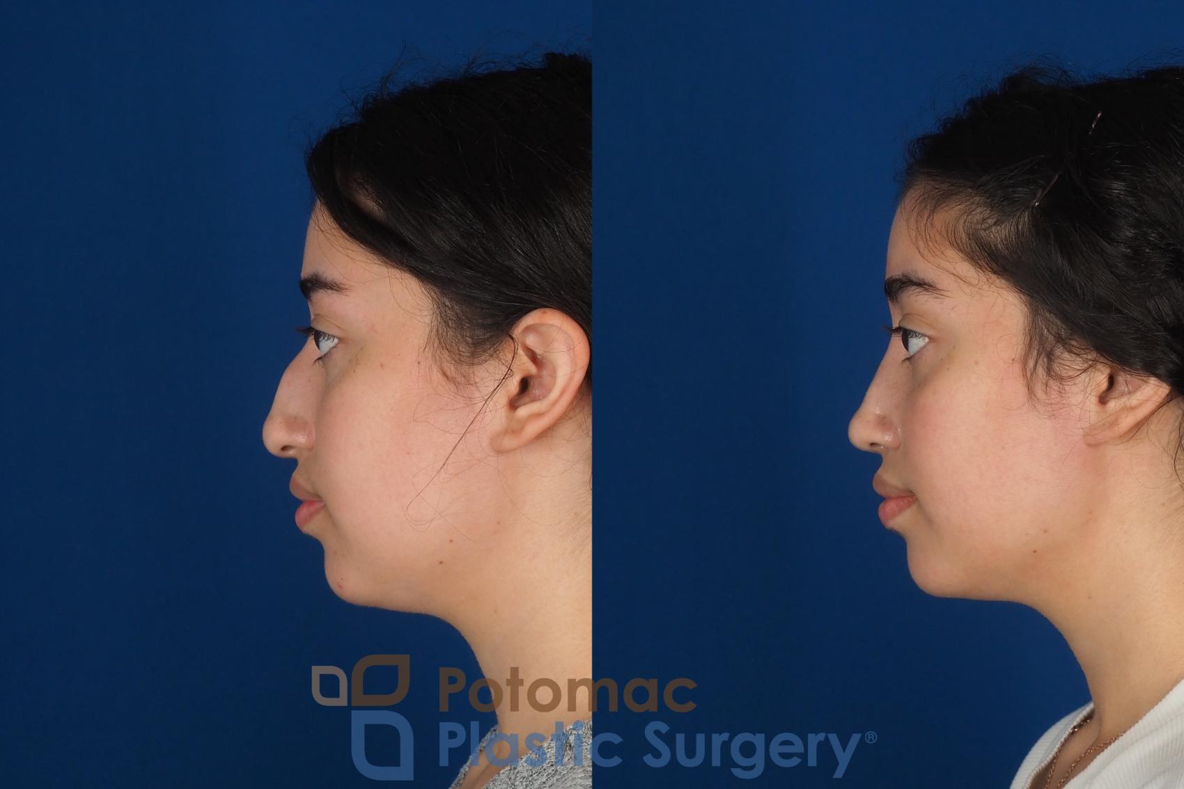 Before & After Rhinoplasty - Cosmetic Case 322 Left Side View in Washington DC & Arlington , DC