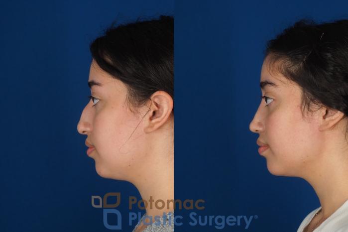 Before & After Rhinoplasty - Cosmetic Case 322 Left Side View in Washington DC & Arlington , DC