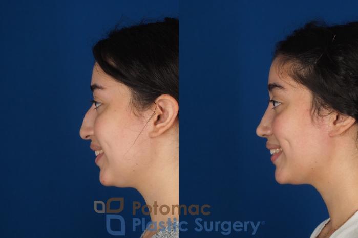 Before & After Rhinoplasty - Cosmetic Case 322 Left - Smiling View in Washington DC & Arlington , DC