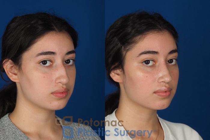 Before & After Rhinoplasty - Medical Case 322 Right Oblique 2 View in Washington DC & Arlington , DC