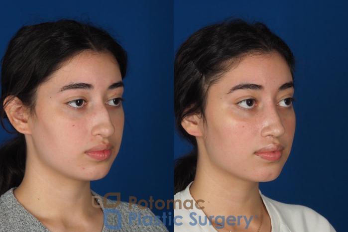 Before & After Rhinoplasty - Medical Case 322 Right Oblique View in Washington DC & Arlington , DC