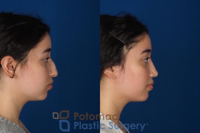 Before & After Rhinoplasty - Medical Case 322 Right Side View in Washington DC & Arlington , DC