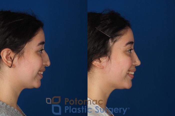 Before & After Rhinoplasty - Medical Case 322 Right - Smiling View in Washington DC & Arlington , DC