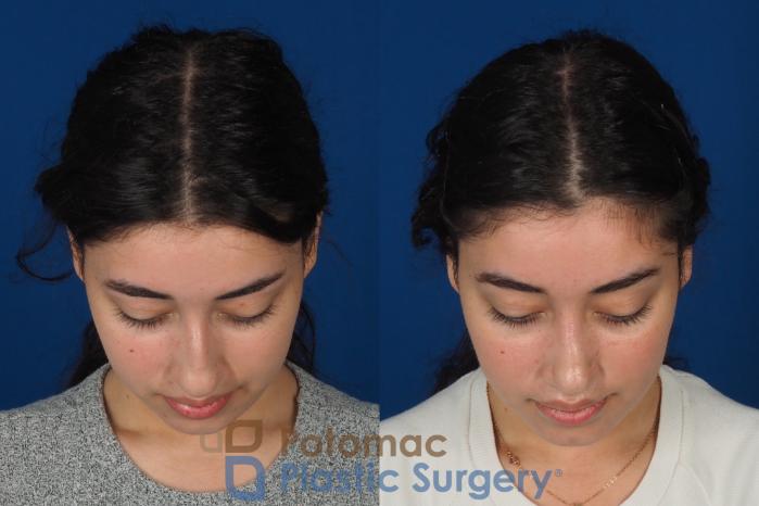 Before & After Rhinoplasty - Medical Case 322 Top View in Washington DC & Arlington , DC